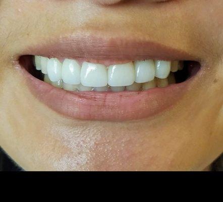 After Cosmetic Veneers  Dentistry is both Science and Art