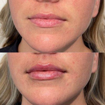 Before and after lip filler