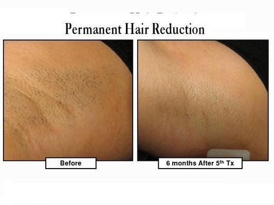 Hair Removal