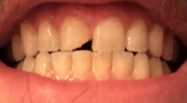 Before photo. Chipped tooth