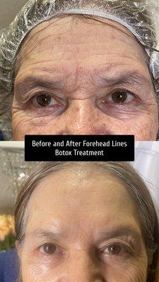 Before and After Botox treated by Nurse Lovella