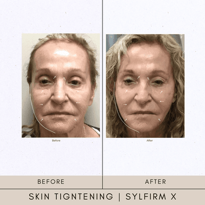 Skin Tightening Sylfirm x