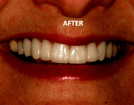 Smile change - AFTER