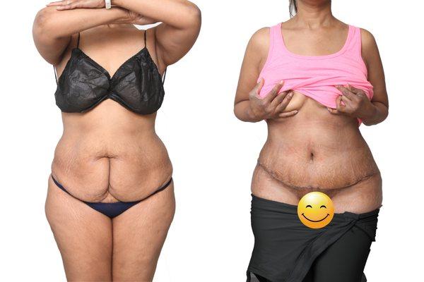 Mommy Makover Tummy Tuck 360 Lipo