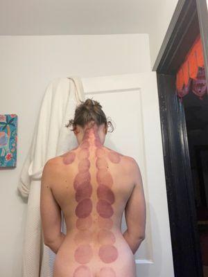 This is completely normal after cupping.