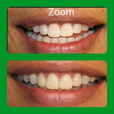 Zoom Whitening is an effective way to whiten your teeth. Call for a consultation.