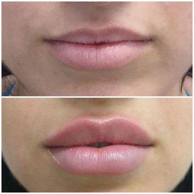 Before and after lip filler #lipfiller #liptreatment #medspa