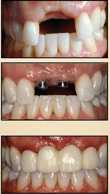 The beauty of dental implants