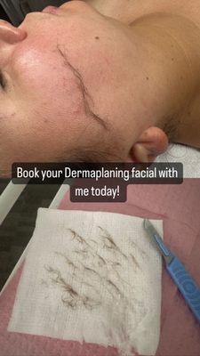 Dermaplaning facial results