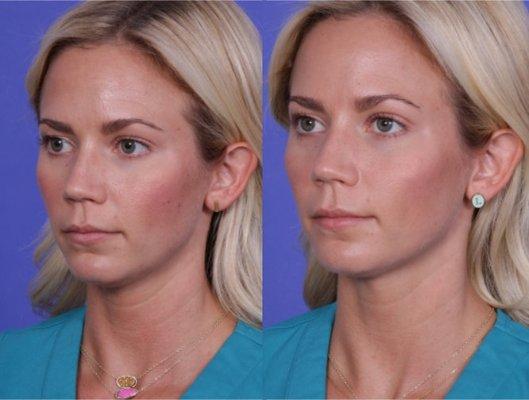 Cheek augmentation