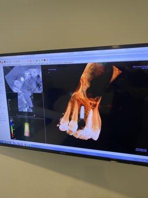 Ct scan for dental implants