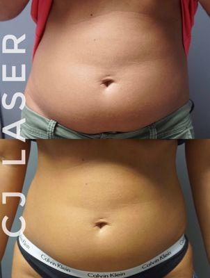 Our Client Who Had Amazing Results With 4 Sessions Of Laser Lipo!