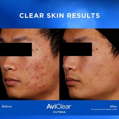 AviClear - get clear skin with 3 treatments. Call us today at 714-839-8000 for more details.