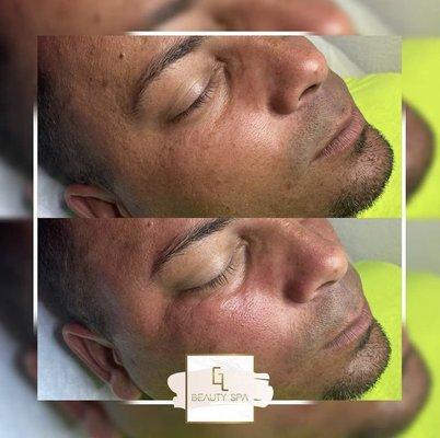 Limpieza facial profunda