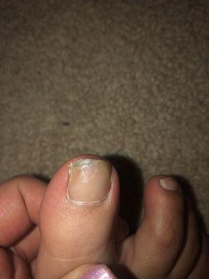 Foot fungus and horrible pedicure job.