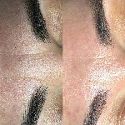 Smoother "11s" and brighter, healthier looking skin after just 1 DMK Skin Revision Treatment.