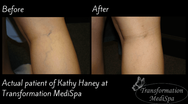 Sclerotherapy treatment performed to eliminate varicose veins.