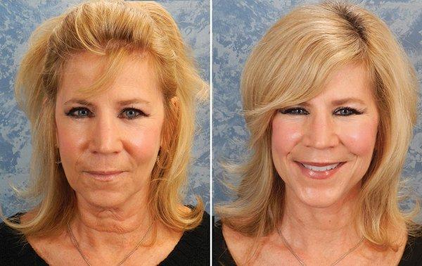 Face Lift