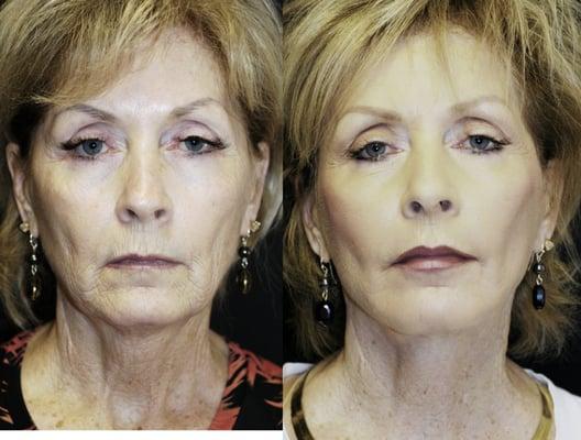 Lower Face and Neck Lift with Laser by Sadove