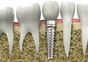 Ask us about dental implants!