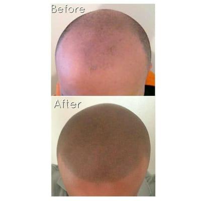 Scalp micropigmentation, Hair replacement tattoo