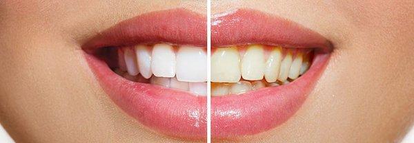 Look how beautifully white your teeth can be after a Professional Session!