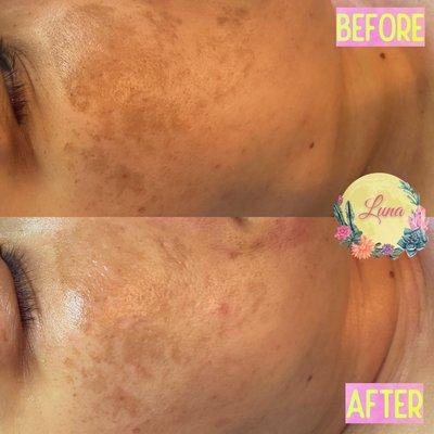 Hyperpigmentation treatment