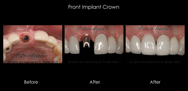 Front Tooth Implant and Crown