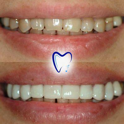 Lumineers here at Honda Plaza Dental - an innovative, mininal prep porcelain veneer treatment for stunning smile results like these!