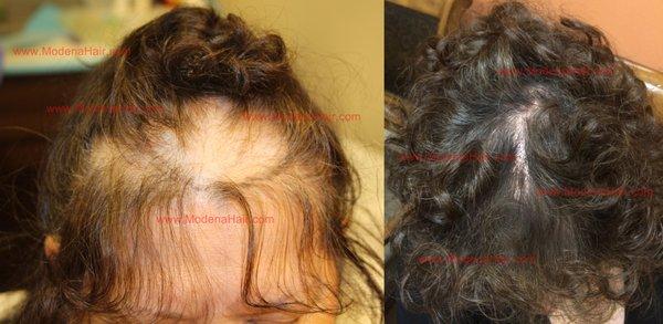 Female patient with frontal hair loss underwent 1 FUT/Strip hair transplant with Dr. Yazdan