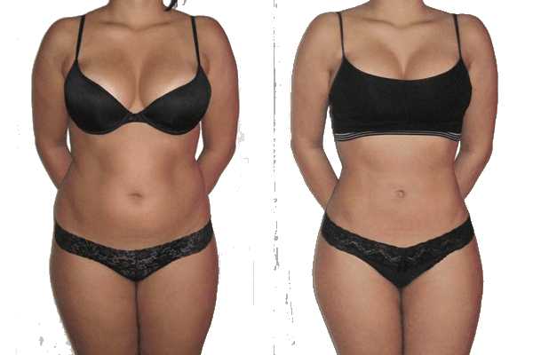 Before & After Non-Invasive Laser Lipo