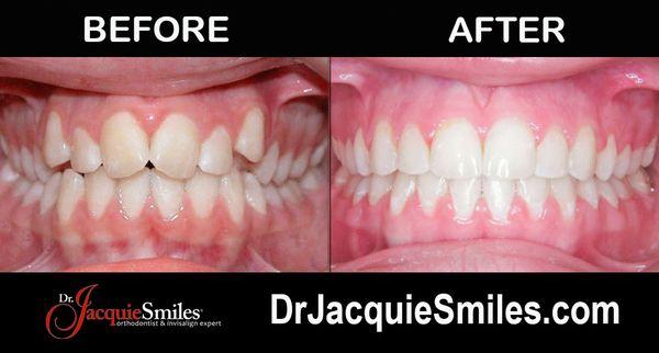 Invisalign before and after photo fo NYC patient.