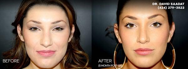 Recent Rhinoplasty Surgery Front View in Beverly Hills, Los Angeles call Dr. Saadat for a consultation (424) 279-3822