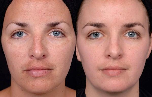 Chemical peels can be used to improve skin tone, texture and clarity and to treat conditions such as acne, hyperpigmentation ...