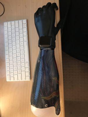 Taber and Hanger Team's life changing prosthetic