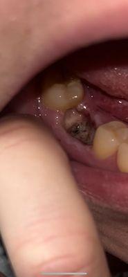 Infection and dry socket