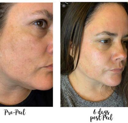 Melasma before and after one Purpeel