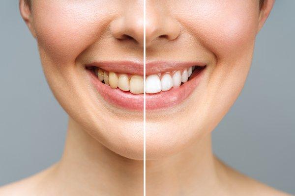 Beaverton Dental Center offer teeth whitening in Beaverton, OR! Start your journey to a whiter, brighter smile today!