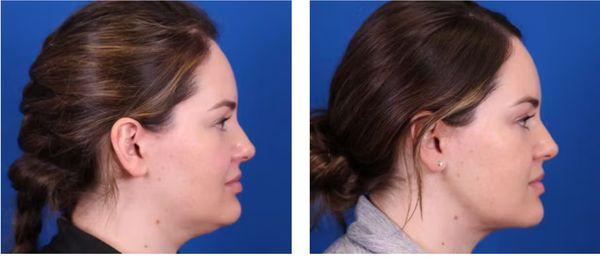 Minimally invasive Neck lift