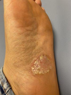 Fungal infection from salon