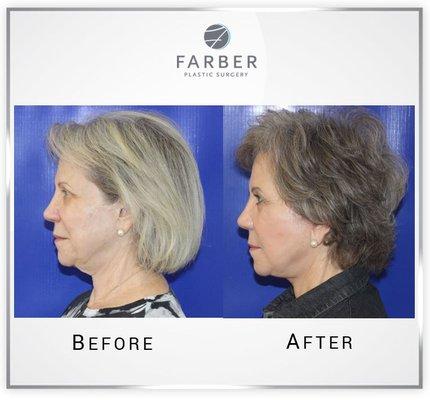 Before and After of Face and Neck Lift