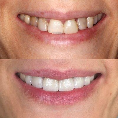 Crowns and veneers