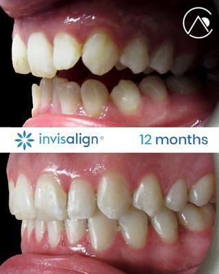 The doctors have advanced training in Invisalign and treat all ages.