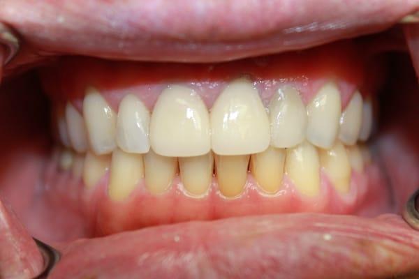 After restoration with new all ceramic crowns.