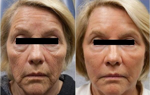 30 days after laser resurfacing