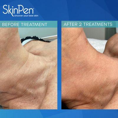 Skinpen treatment for the neck area