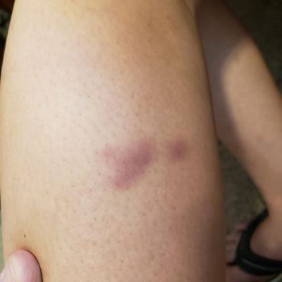 Rape bruises