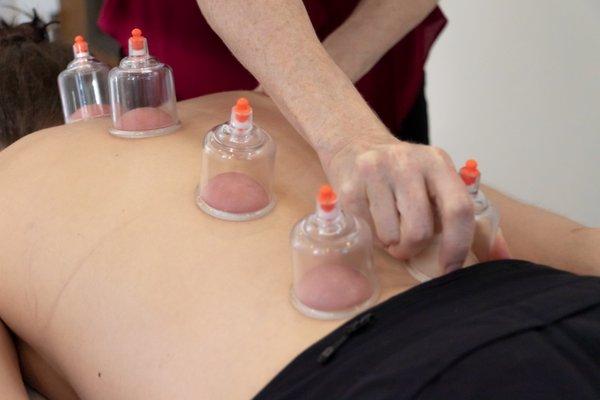 Cupping