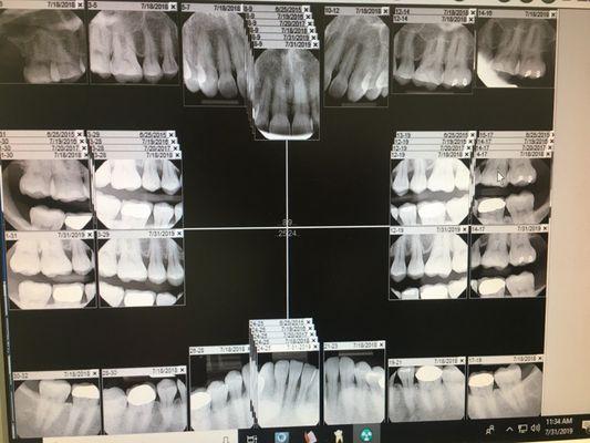 X-Rays are on a screen right in front of you so you can clearly see them!  :)