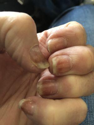 Nail bed infection